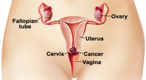 what-causes-cervical-cancer